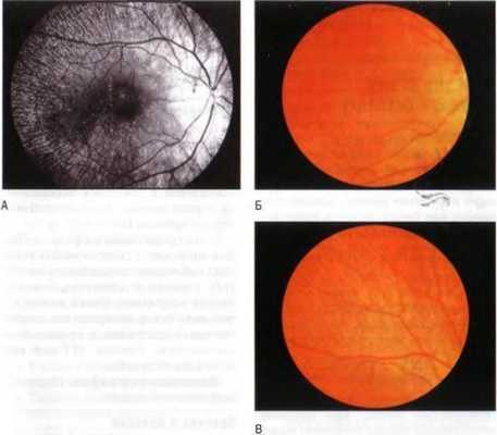 Белоточечное глазное дно