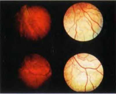 Феномен Мицуо-Накамура