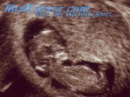 вентрикуломегалия