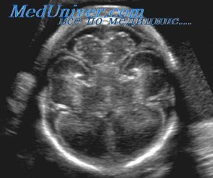 врожденная гидроцефалия