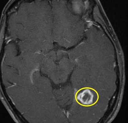 Туберкулема