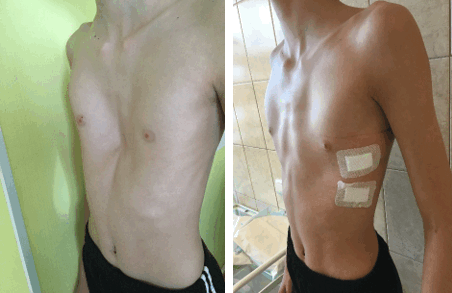 впалая грудь, ВДГК