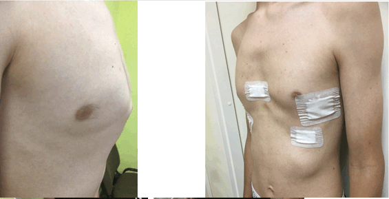 килевидная грудная клетка