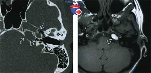 КТ, МРТ при холестериновой гранулеме вершины пирамиды височной кости