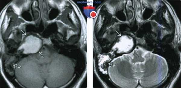 КТ, МРТ при холестериновой гранулеме вершины пирамиды височной кости