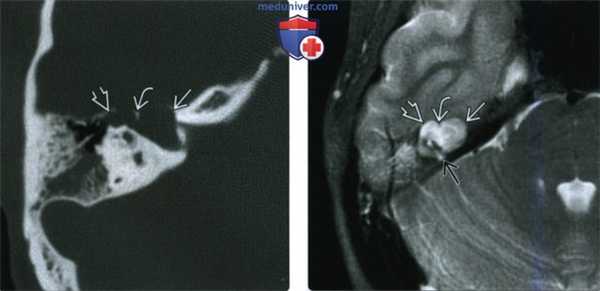 КТ, МРТ при врожденной холестеатоме вершины пирамиды височной кости