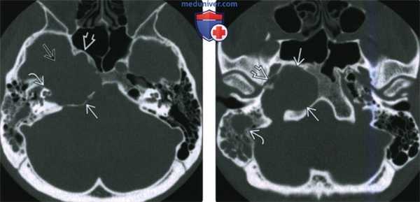 КТ, МРТ при холестериновой гранулеме вершины пирамиды височной кости