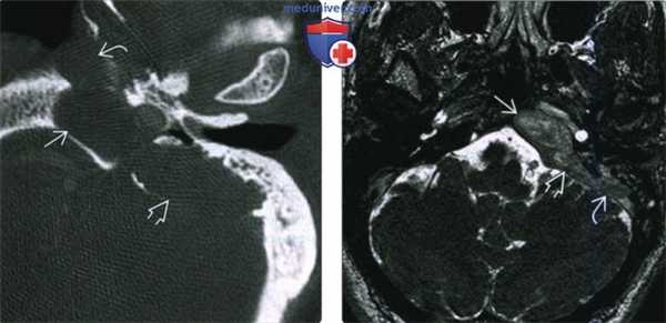 КТ, МРТ при врожденной холестеатоме вершины пирамиды височной кости