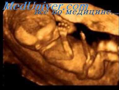 врожденные ампутации у плода