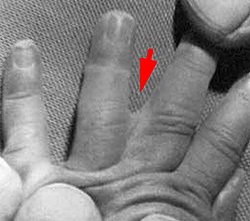 Синдактилия