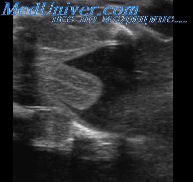 артрогрипоз плода