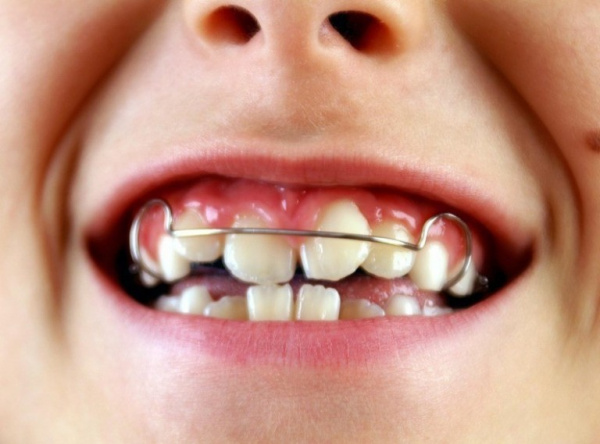 Аномалии зубов