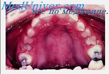 зубочелюстные деформации