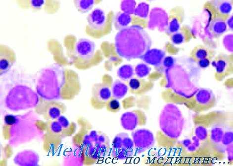 мазок крови при врожденной дизэритропоэтической анемии