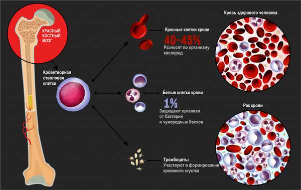 Рак крови.jpg