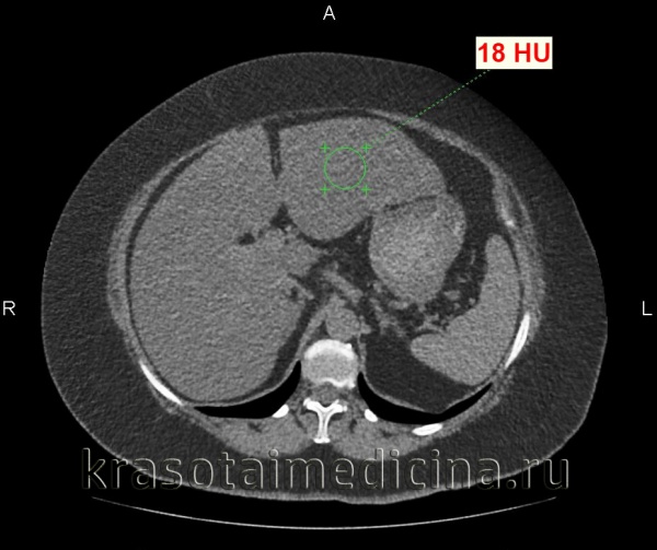 КТ органов брюшной полости. Диффузное снижение плотности печени до +12 ед.