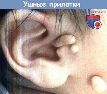 Множественные ушные придатки