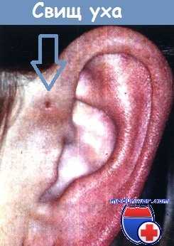 Преаурикулярный свищ уха