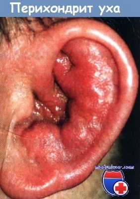 Перихондрит ушной раковины