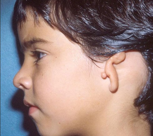 Отсутствие уха и/или мочки