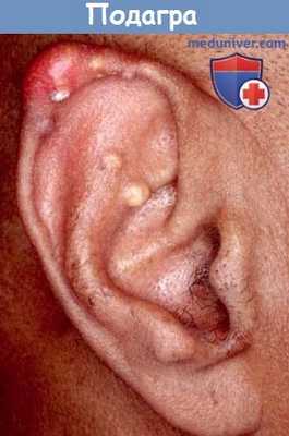 Подагрический тофус