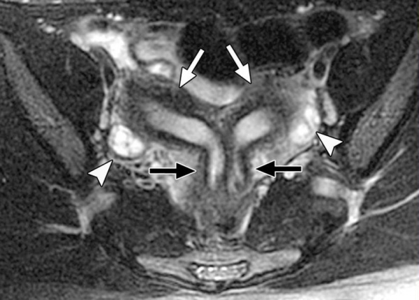 Удвоение матки