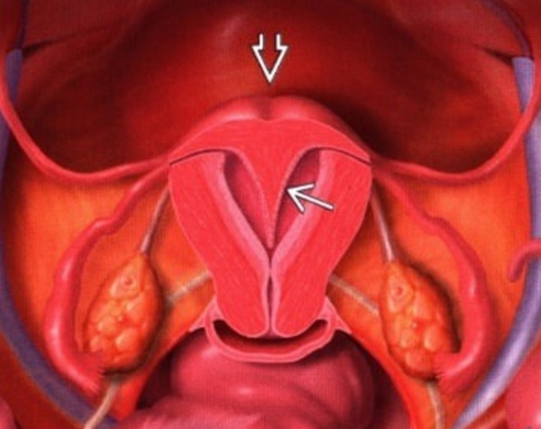 Аномалии девственной плевы