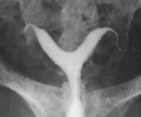 Седловидная матка