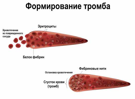 Формирование тромба.jpg