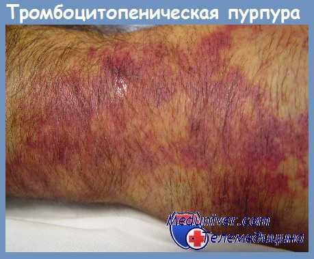 Тромбоцитопеническая пурпура