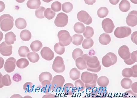 тромбоцитопении у детей