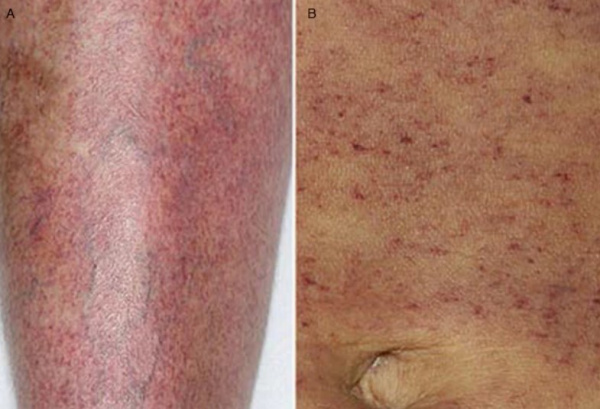 Петехиальная сыпь на ноге (А) и на животе (В)