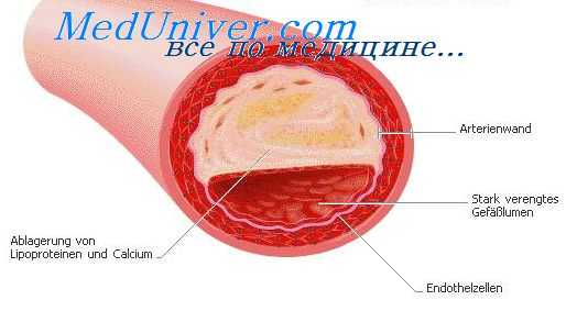 заболевания артерии