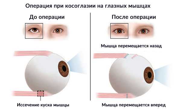 Операции при косоглазии