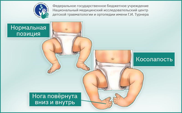 Артрогрипоз у детей и подростков: эффективные методы лечения в РФ