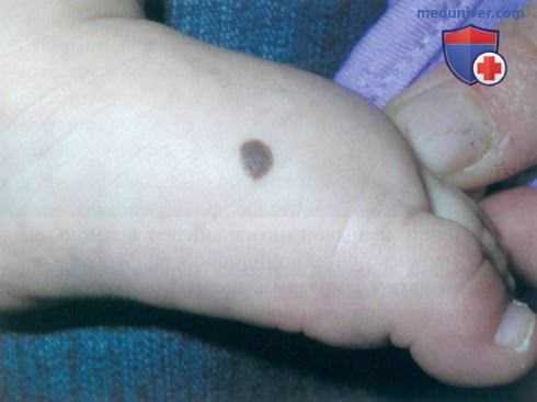 Врожденный невус