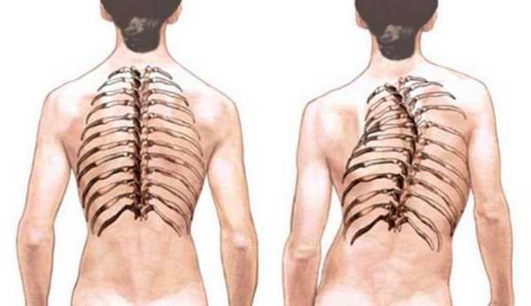 Сколиоз грудного отдела
