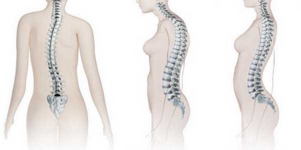 Поясничный лордоз