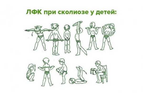 ЛФК при сколиозе у детей