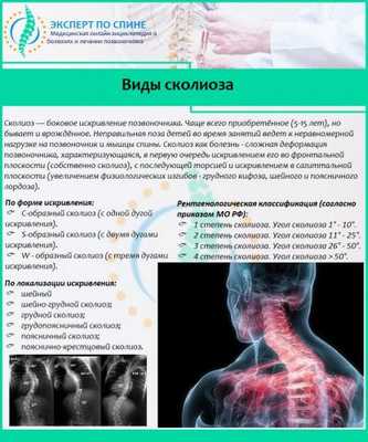 Виды сколиоза