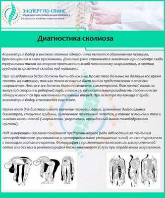 Диагностика сколиоза
