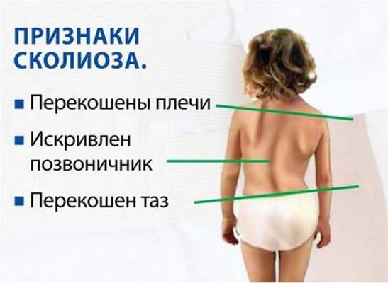 Признаки сколиоза