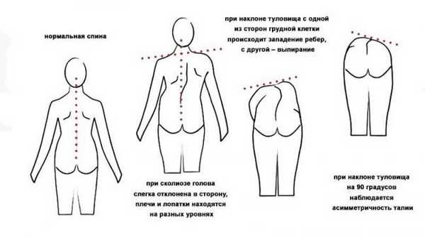 Симптоматика сколиоза