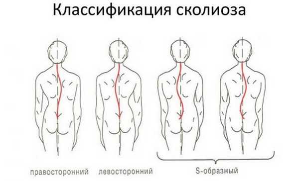 Классификация сколиоза
