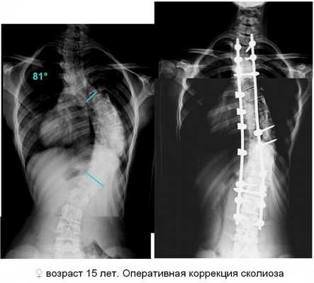 Оперативная коррекция сколиоза