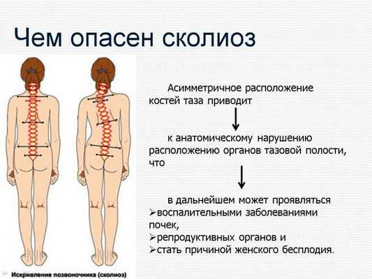 Чем опасен сколиоз