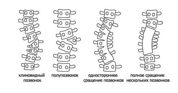 Распространённые виды врождённых деформаций позвоночника