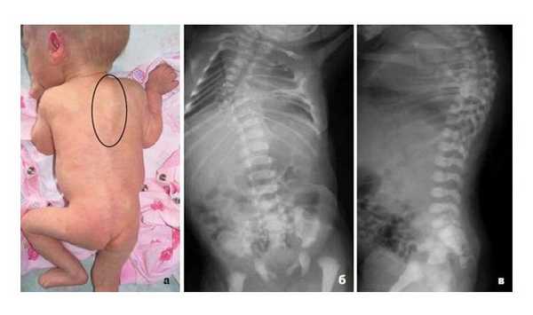 Младенец с врождённой деформацией позвоночника