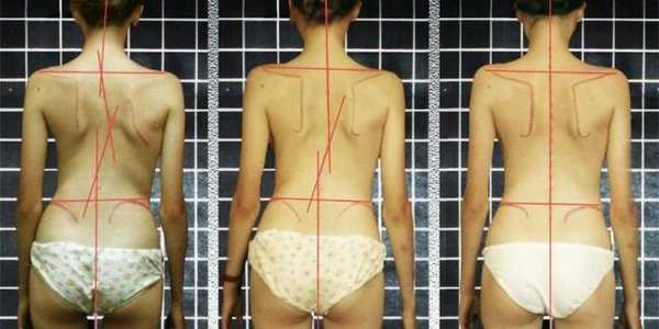 Искривления позвоночника