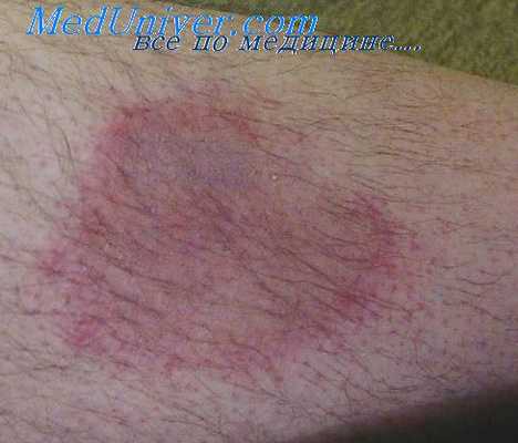 врожденный токсоплазмоз